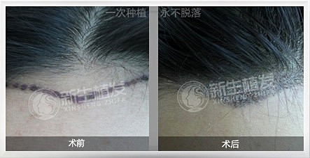 新生植发美人尖种植的效果自然吗