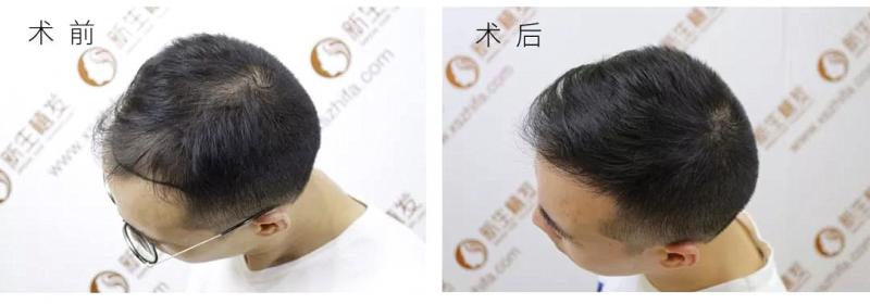 怎样判断植发效果的好坏