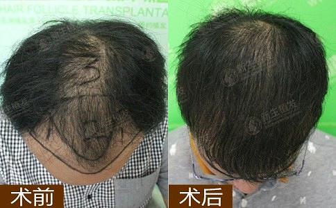 昆明植发的效果怎么样？