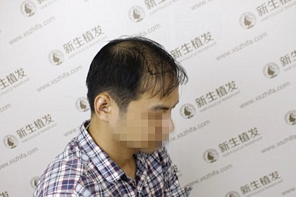 新生植发到底怎么样