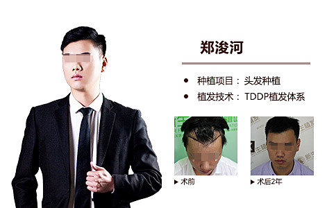 发际线种植秋之旅，秀发再回十年前
