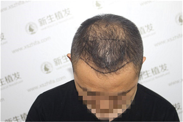 深圳治疗五级脱发去哪里植发好