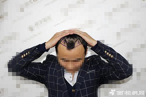 解决男性脱发，就到福州新生植发