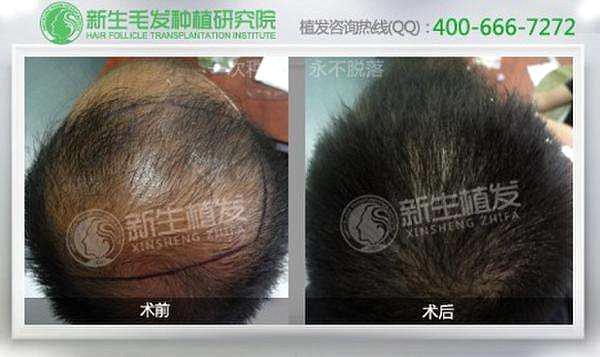头发种植后注意事项
