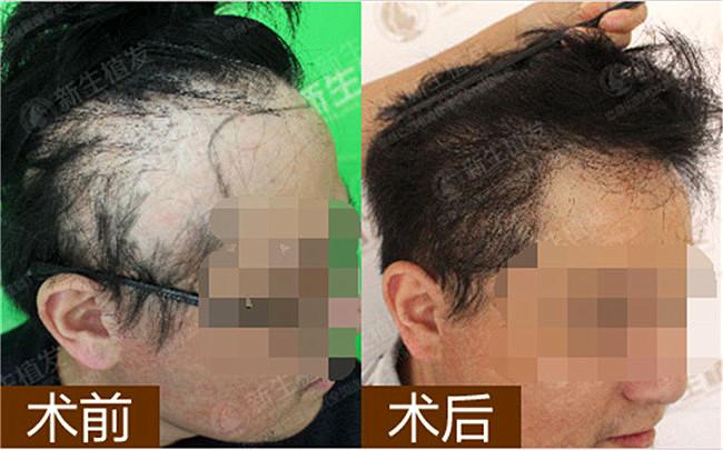 植发效果一般怎么样？