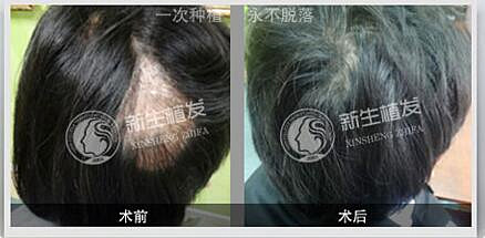 做毛发种植有禁忌症吗？