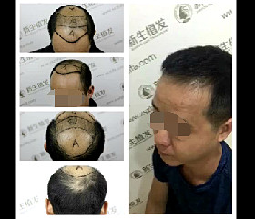 掉发脱发怎么治？新生植发解密脱发怎么治疗效果好