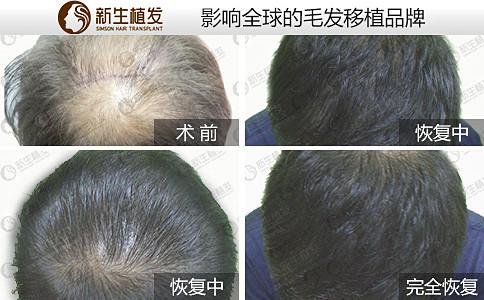 南京植发有用吗？