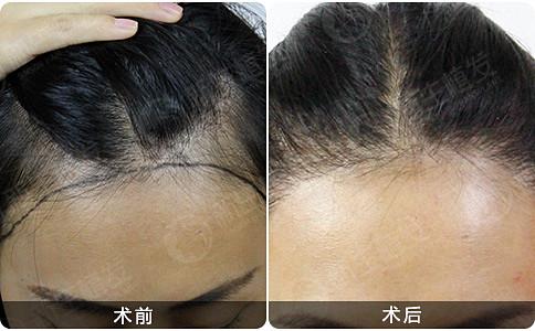 植发是仅有能够治疗脱发的方法吗？