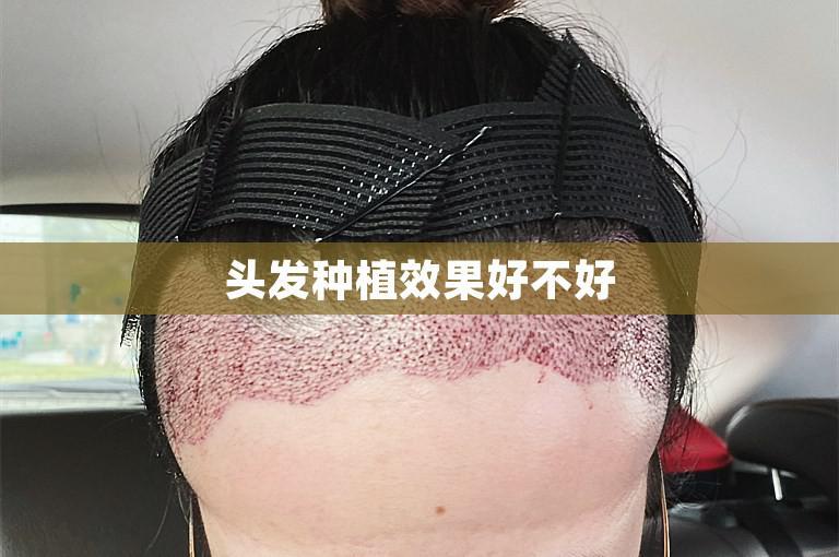 头发种植效果好不好
