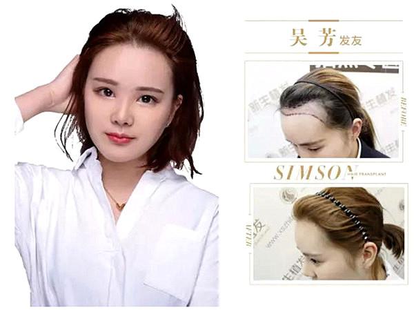 头顶脱发了不要紧植发使头发再生？