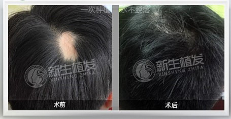 植发手术对于脱发治疗有用吗