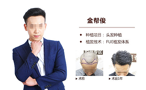 脱发掉发新生植发一次解决！