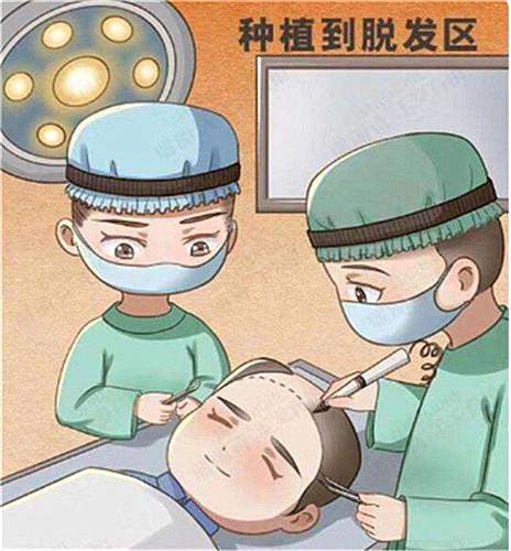 男性脱发后植发效果如何
