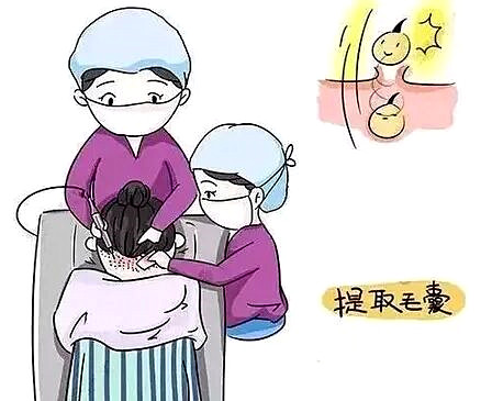 植发可以彻底治疗脱发吗？