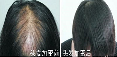 头发加密对身体有什么副作用吗？