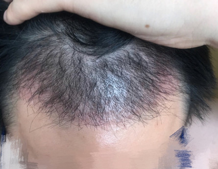 植发后为什么会出现毛囊炎呢