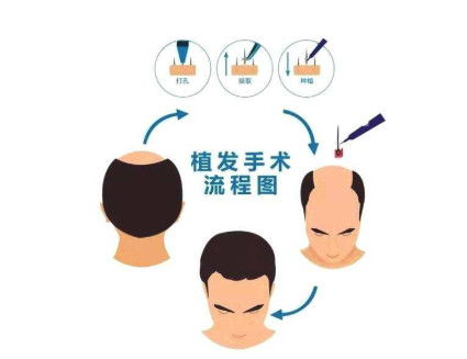 现在的植发技术怎么样呢