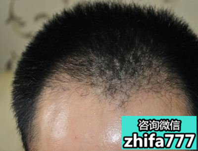 度过植发脱落期的方法你们都清楚吗？
