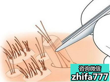 植发为什么不能用别人的毛囊