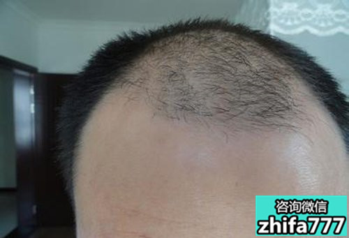 运动对植发好不好