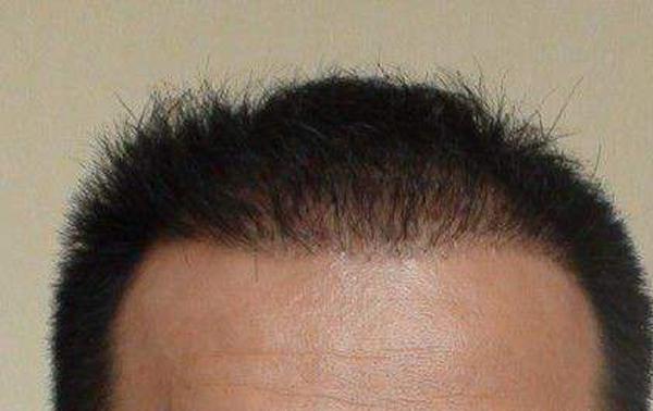 怎样判断什么时候植发？
