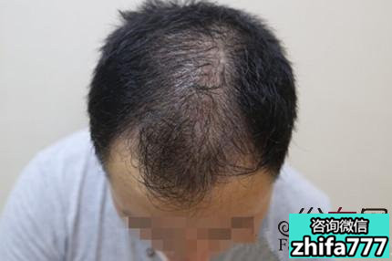 脱发选择植发真的好吗？