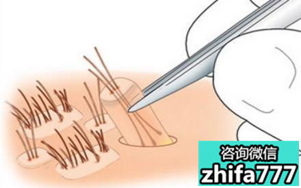 植发手术后的效果怎么样