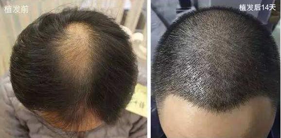 植发对身体好不好呢
