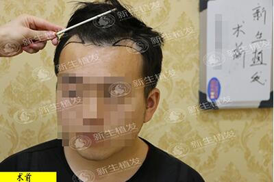 在合肥新生做了1500毛囊单位的发际线移植