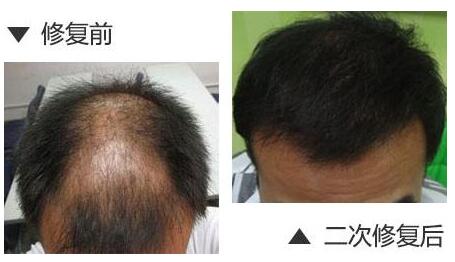 现在植发手术都有什么技术？
