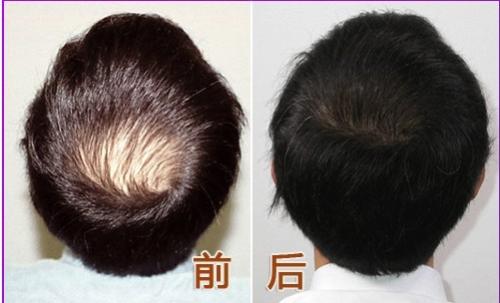 植发手术会对人体产生坏处吗？