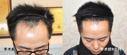 植发可靠吗？植发真的能解决脱发的问题吗？