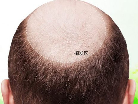 植发手术能治好脱发问题吗？