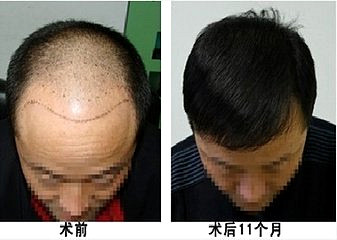 Fue植发治疗男性脱发有用吗