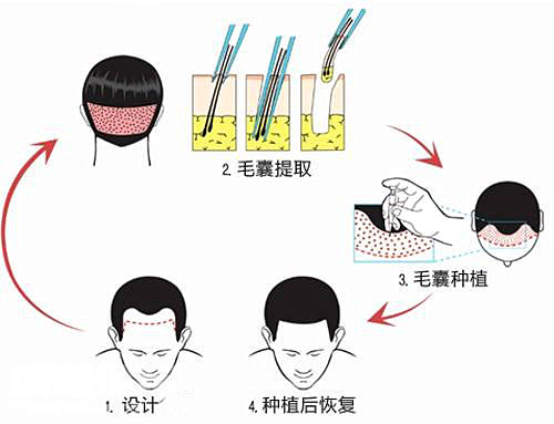植发的成功率是多少