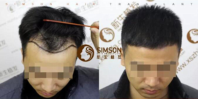 新生植发如何治疗脱发？