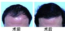 头发种植效果明显吗