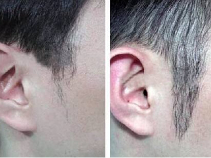 秃鬓角怎么治疗