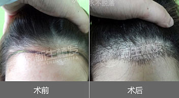 美人尖种植安然可靠吗