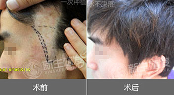 南京鬓角移植相关知识