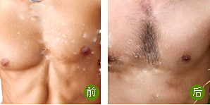 怎样让胸毛变多？