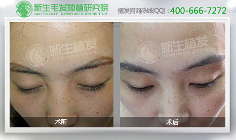 眉毛种植，柳叶眉不是梦