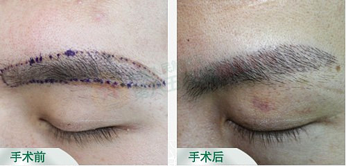 眉毛短不好看怎么办