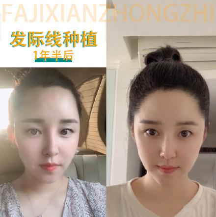 苏州植发他们的植发效果都不错，在苏州哪植发的