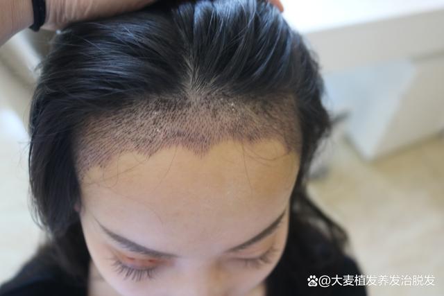 植发之前后要搞清楚这几点！