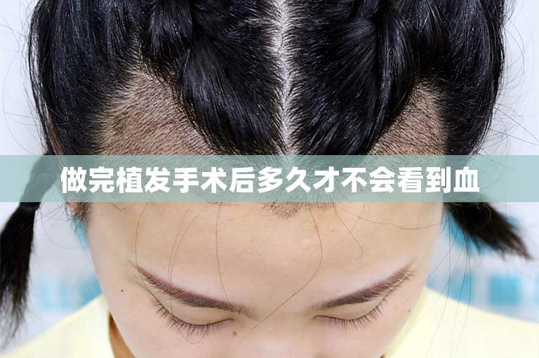 做完植发手术后多久才不会看到血