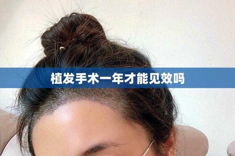 植发手术一年才能见效吗