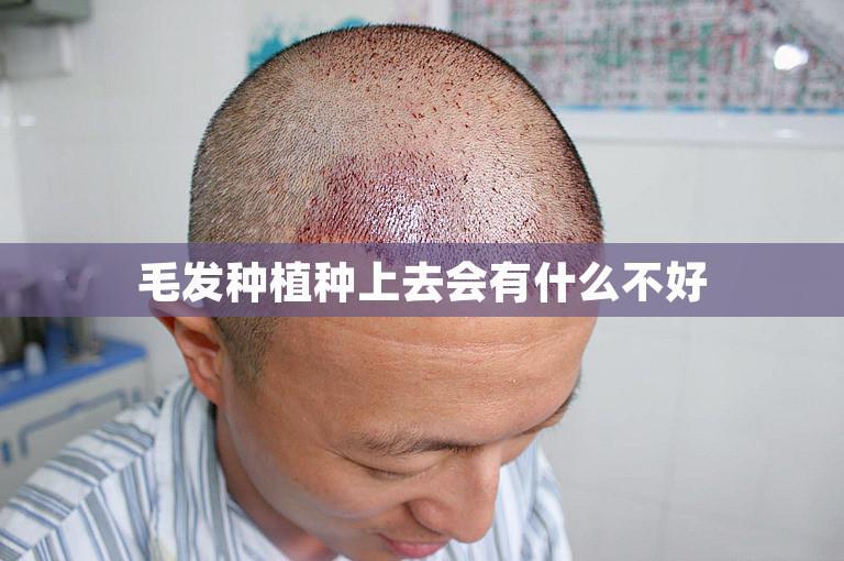 毛发种植种上去会有什么不好