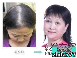 植发术后怎么正确护理头发